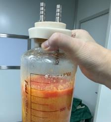 阜新水动力吸脂手术要做多久？